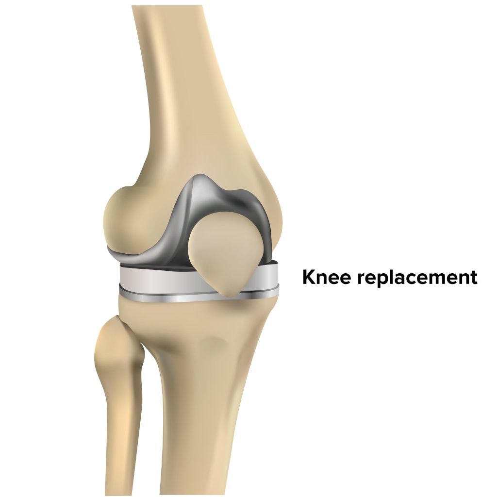 knee replacement in Thrissur